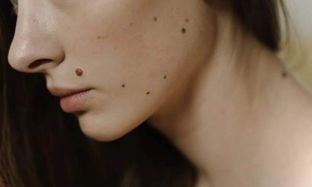 What to Know About Moles, Skin Changes, and Medical Assessment
